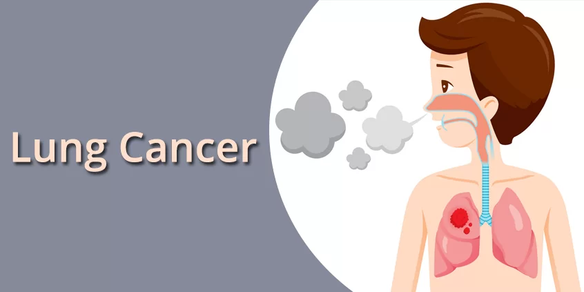 Lung Cancer Treatment in Jaipur