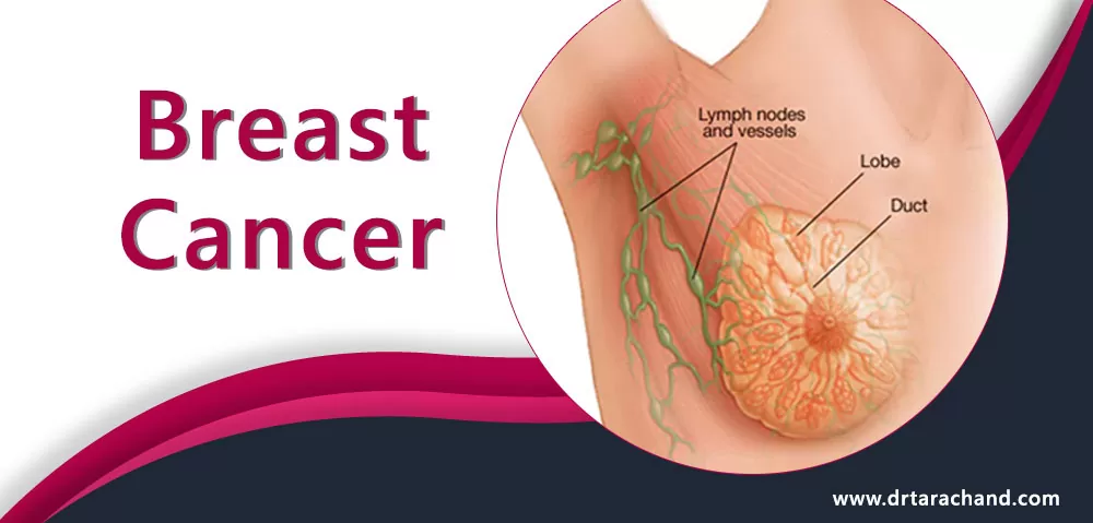 Breast cancer