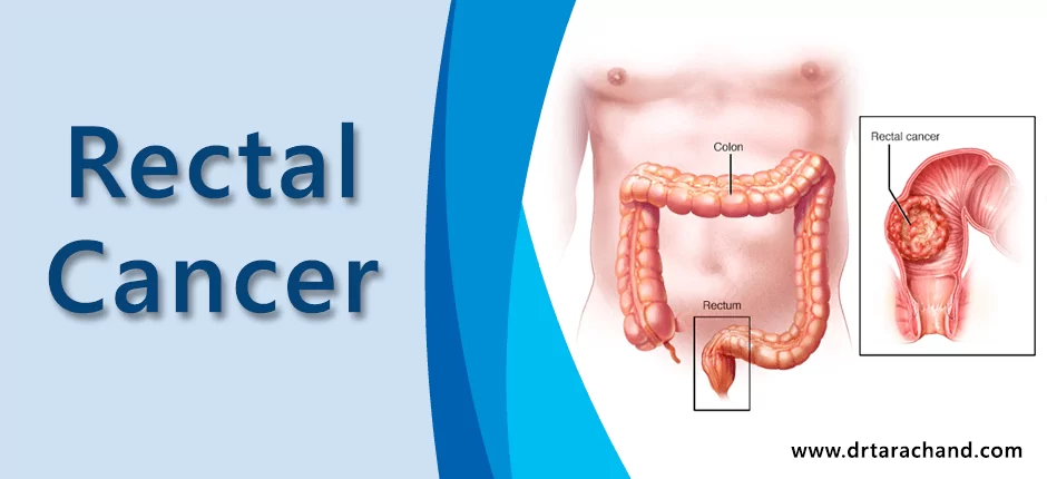 Rectal Cancer