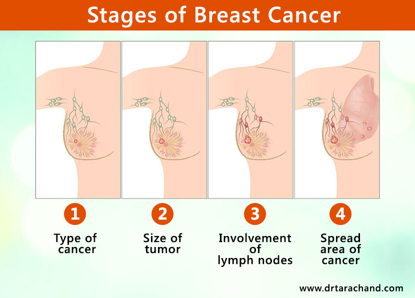 Stages of Breast cancer
