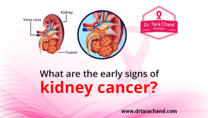 What are the Early Signs of Kidney Cancer in 2022?