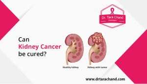 Can Kidney Cancer Be Cured? Latest Treatment And Survival Insights