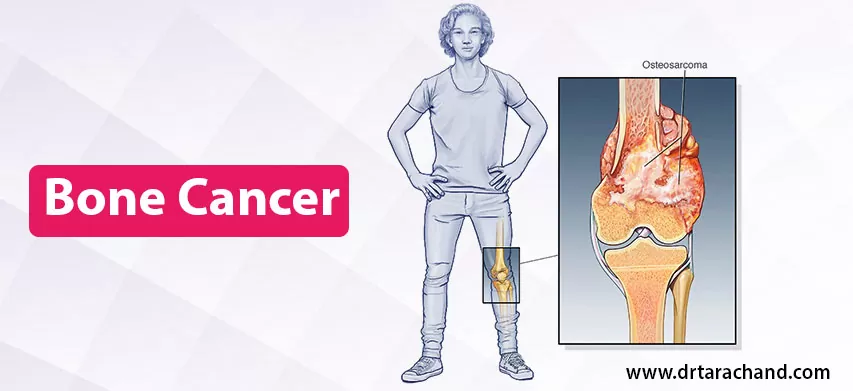 Adenocarcinoma Cancers: Symptoms, Causes, Diagnosis & Treatment