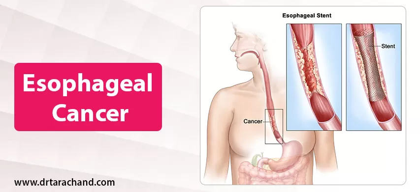 Esophageal Cancer Treatment in Jaipur