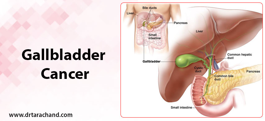 Gallbladder Cancer Treatment in Jaipur