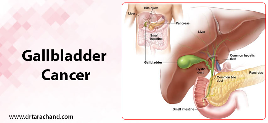 Gallbladder Cancer Treatment in Jaipur