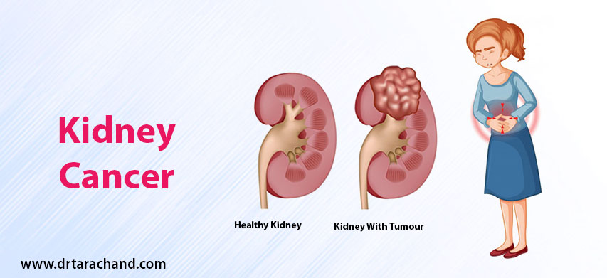 Kidney Cancer Treatment in Jaipur