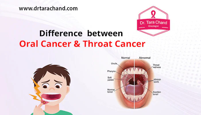 Difference Between Oral Cancer & Throat Cancer