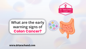 What are the early warning signs of colon cancer in 2022?