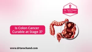 Is Colon Cancer Curable at this Stage 3 in 2022?
