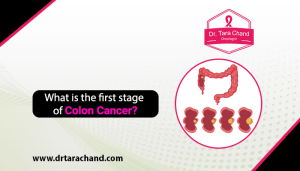 What is the first Stage of Colon Cancer in 2022?
