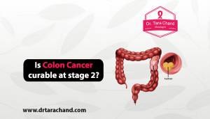Is colon cancer curable at stage 2 in 2022?