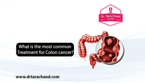 What is the most Common Treatment for Colon Cancer in 2022?