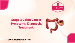 Stage 3 Colon Cancer: Symptoms, Diagnosis, and Treatment 2022