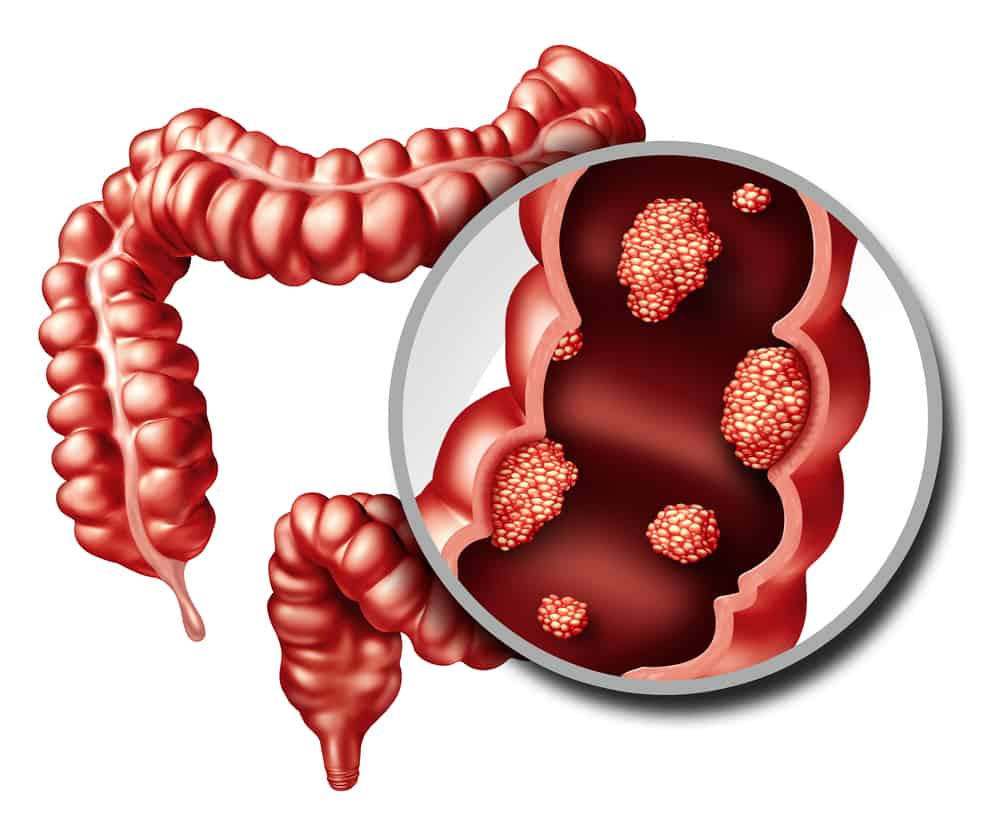 What is Colorectal Cancer Hindi