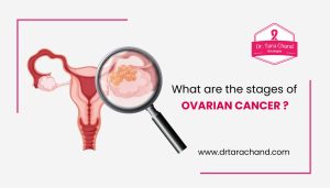 What are the stages of ovarian cancer?