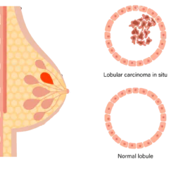 Lobular-carcinoma