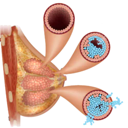 ductal-carcinoma