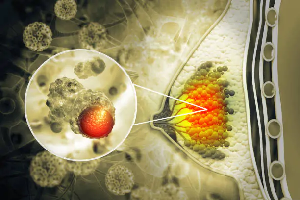 Breast Cancer Symptoms