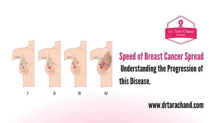 Speed of Breast Cancer Spread: Understanding the Progression of this Disease.