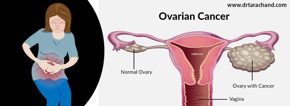 Ovarian cancer