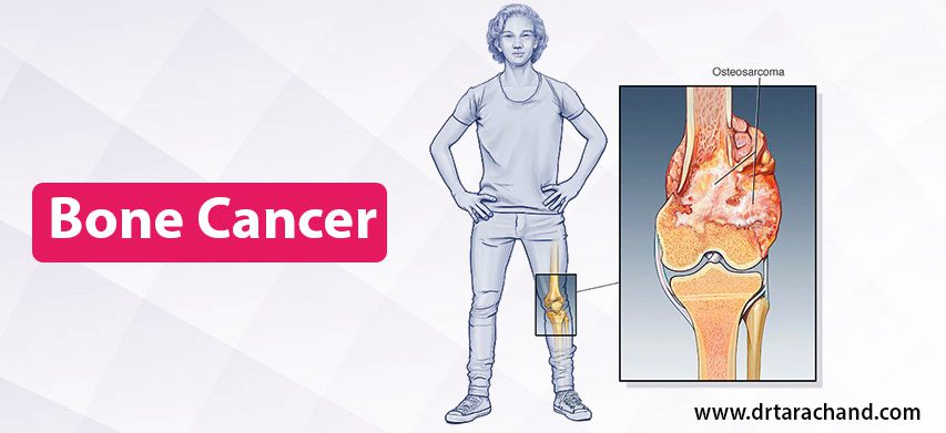 Bone Cancer