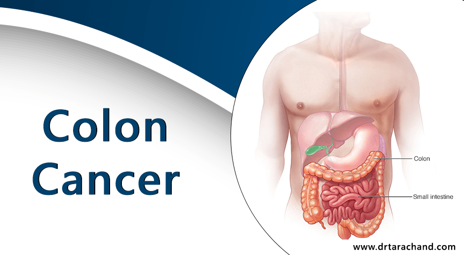 Colon-Cancer