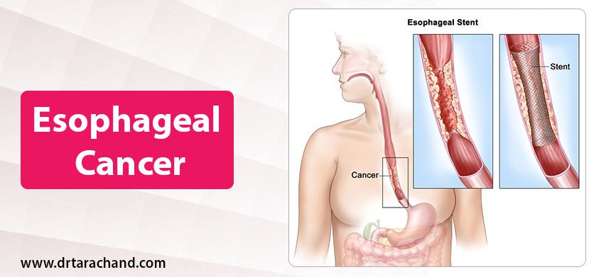 Esophageal Cancer