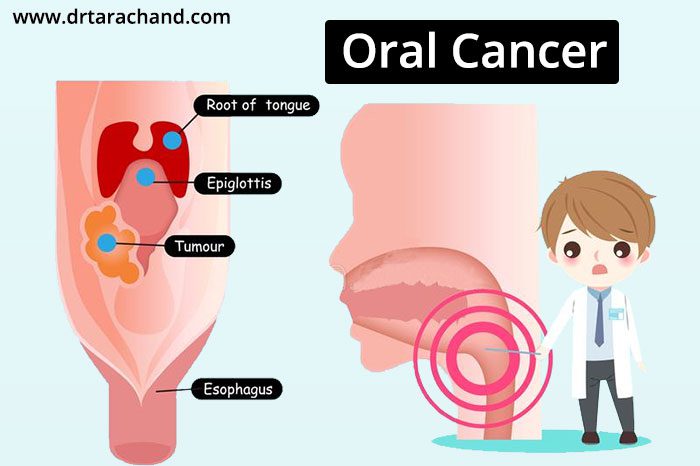 Oral Cancer