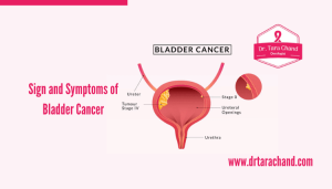 Sign and Symptoms of Bladder Cancer