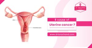 8 causes of uterine cancer