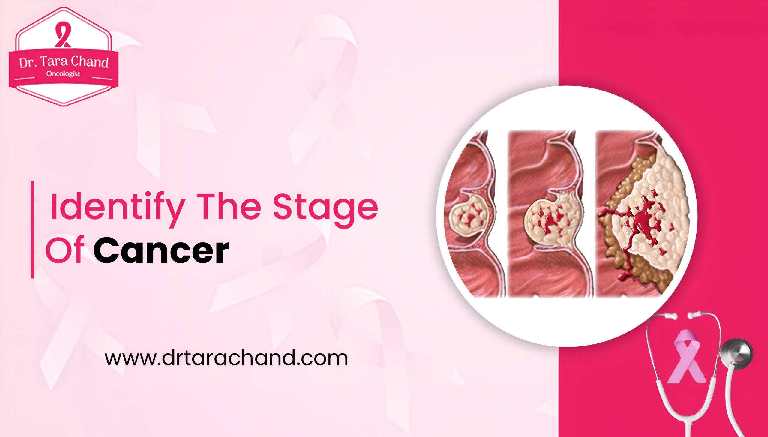 Identify the Stage of Cancer