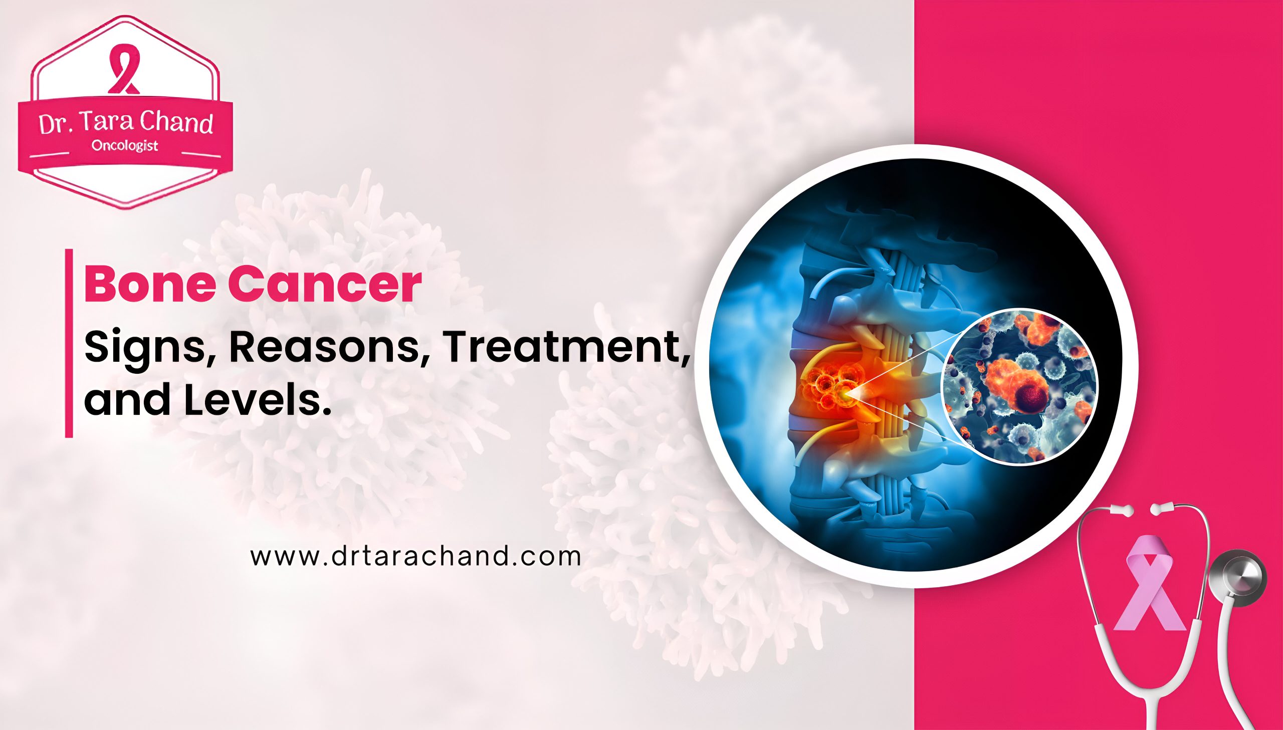 Bone Cancer: Signs, Reasons, Treatment, and Levels