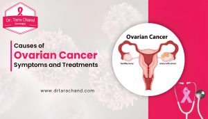 Causes of Ovarian Cancer, Symptoms and Treatments