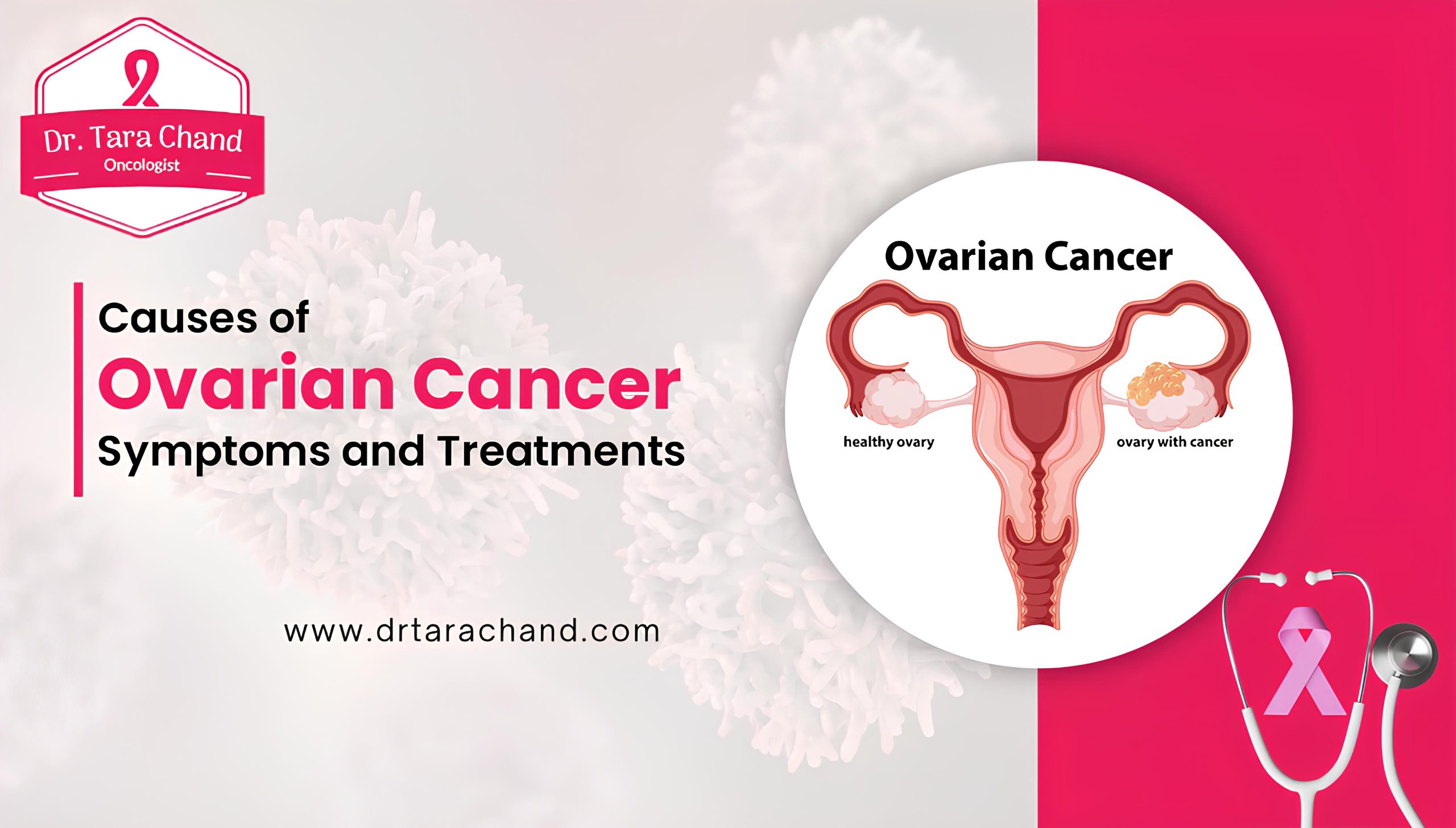 Causes of Ovarian Cancer, Symptoms and Treatments