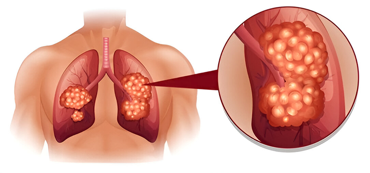 Lung Cancer