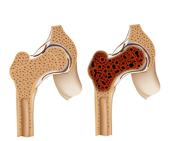Bone cancer treatment in Jaipur 