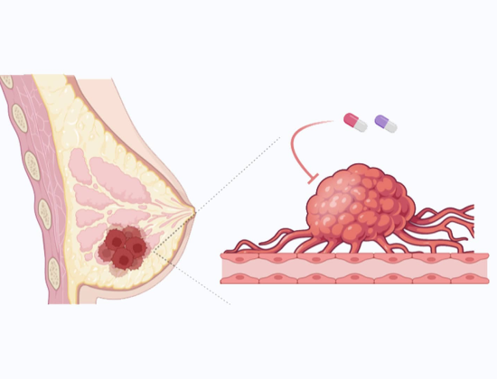 Breast Cancer overview