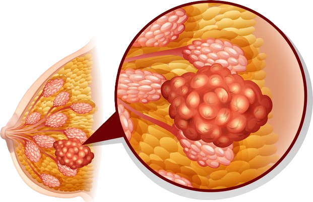 Breast cancer treatment in Jaipur
