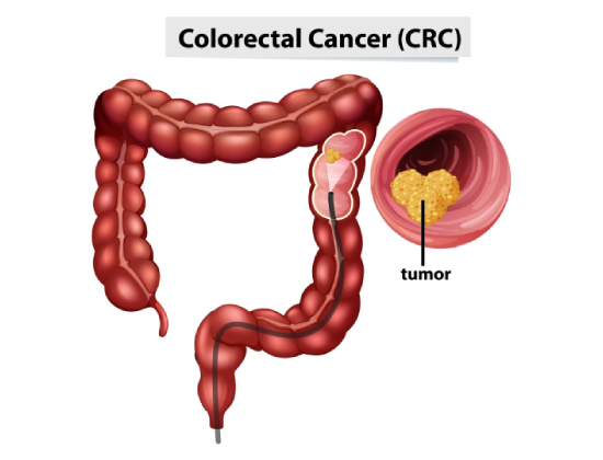 Colon cancer treatment in Jaipur