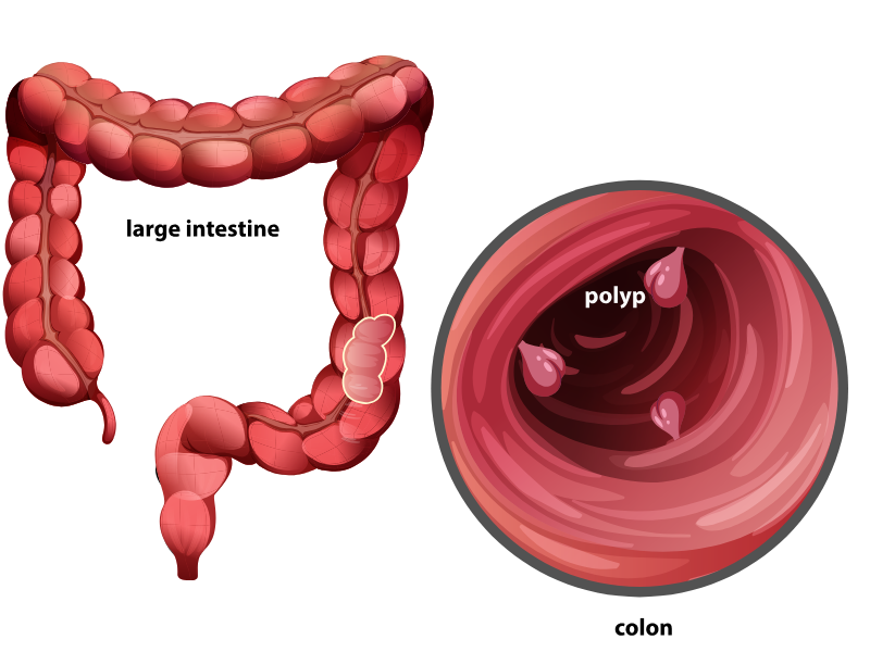 Colon cancer treatment in Jaipur