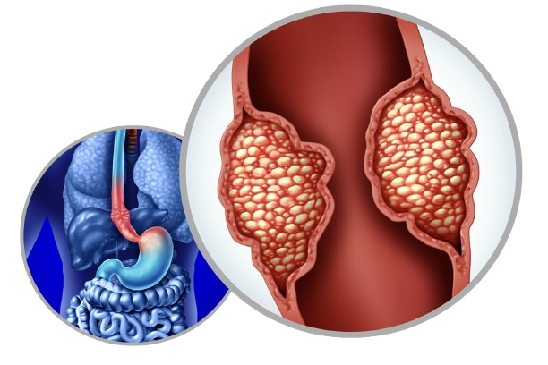 Esophageal Cancer Treatment in Jaipur