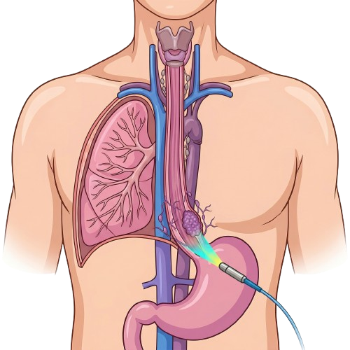 Esophageal cancer treatment in Jaipur 