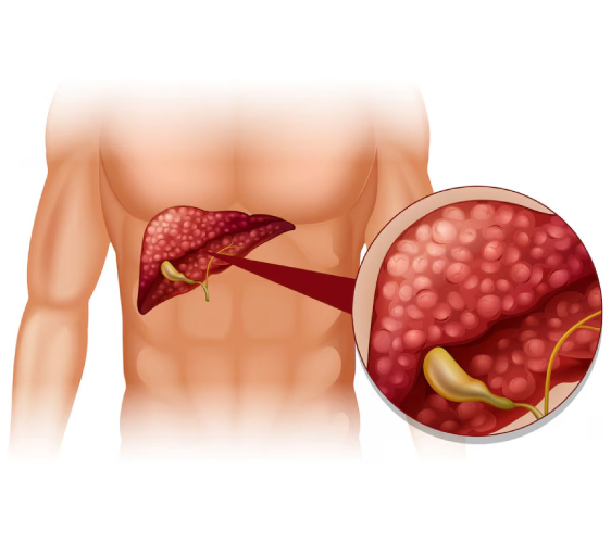Gallbladder Cancer Treatment in Jaipur
