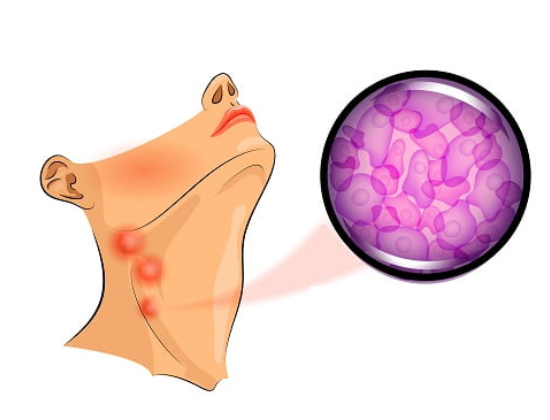 Lymphoma Cancer Treatment in Jaipur