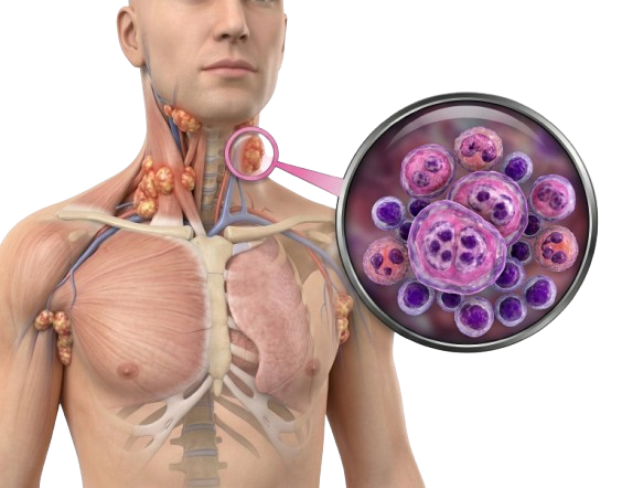 Lymphoma cancer treatment in Jaipur