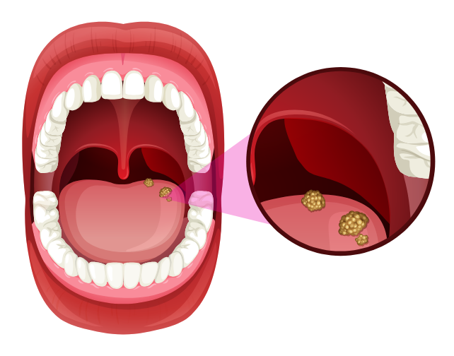  Oral Cancer