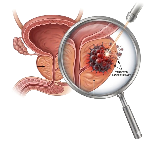 Prostate cancer treatment in Jaipur