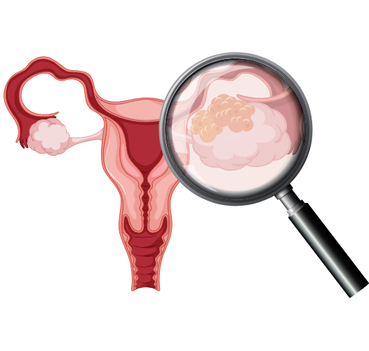 Uterine Cancer overview