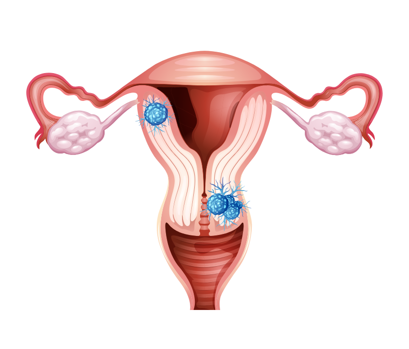 Uterine cancer treatment in Jaipur